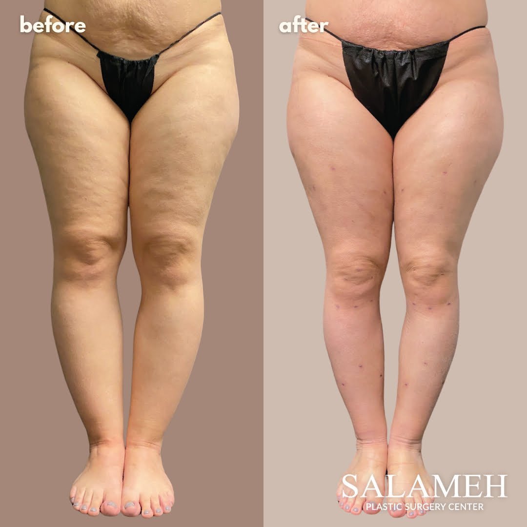 Lipedema Vs Cellulite Understanding The Differences Treatment Options