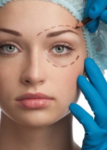 woman marked eyes to undergo eyelid lift surgery