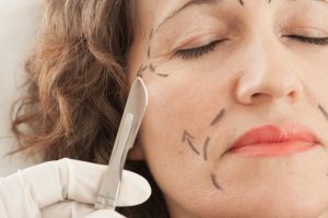 Eyelid Surgery Procedure