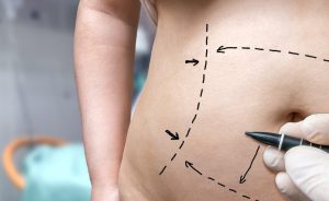 marked belly to undergo liposuction