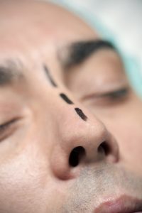 marked nose to undergo nose job