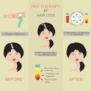 prp therapy for hair loss infographic