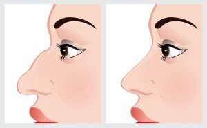 cartooned image showing before and after rhinoplasty