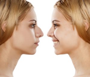 womans face before and after rhinoplasty procedure