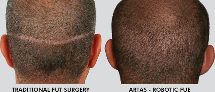 Hair Restoration Surgery Comparison