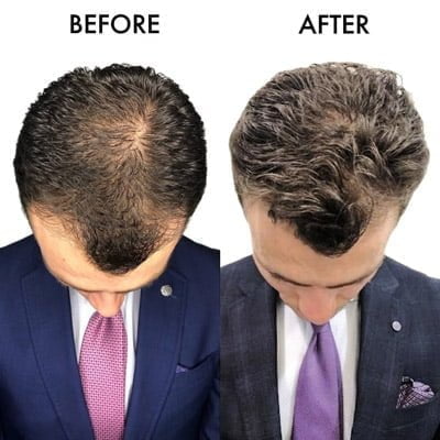 Before and after picture of hair transplant