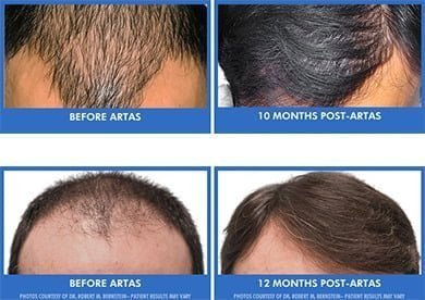 Know the Stages of Hair Loss