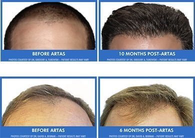 Post Hair Transplant | Haircuts After Hair Transplant