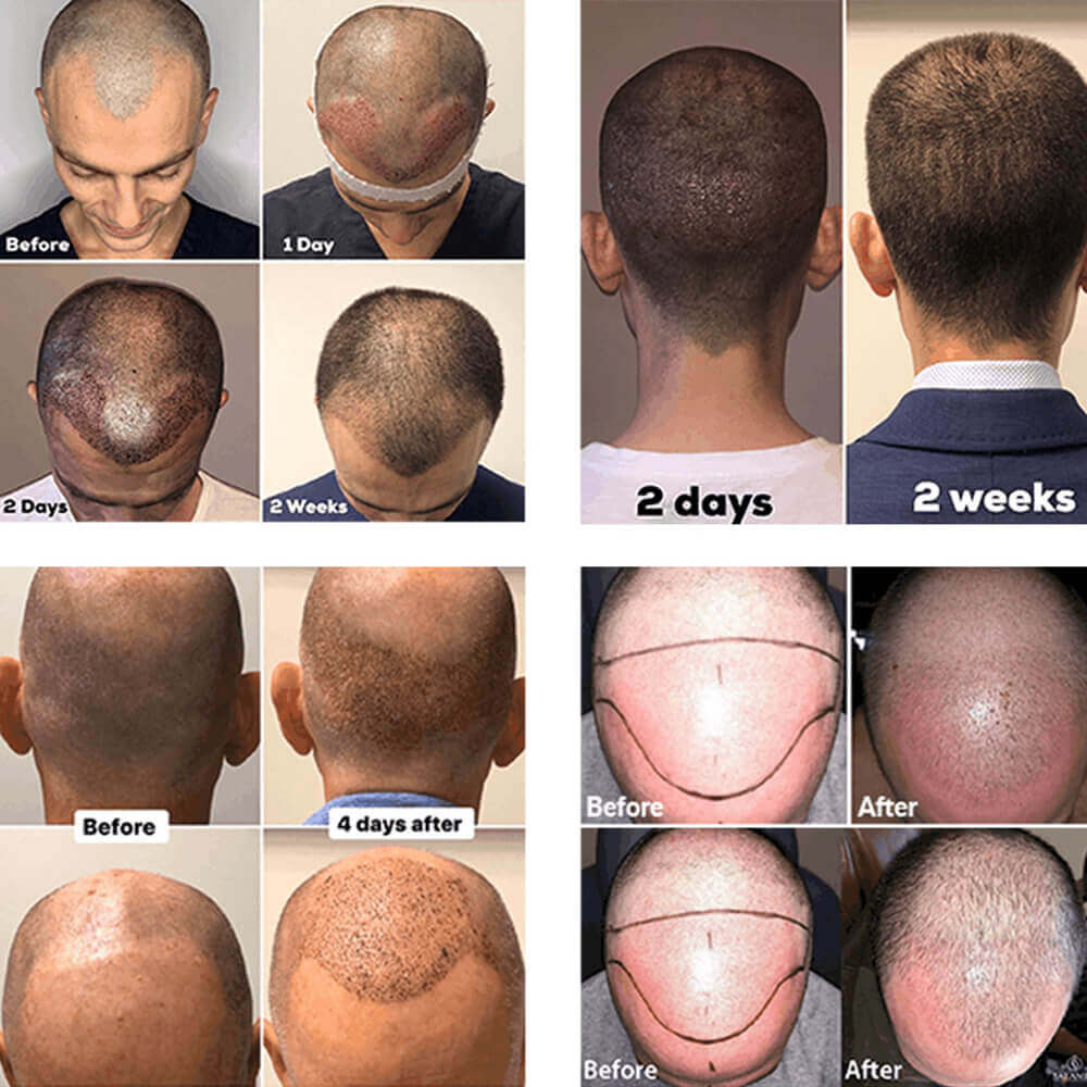 Hair Restoration Options | Hair Transplant Procedure