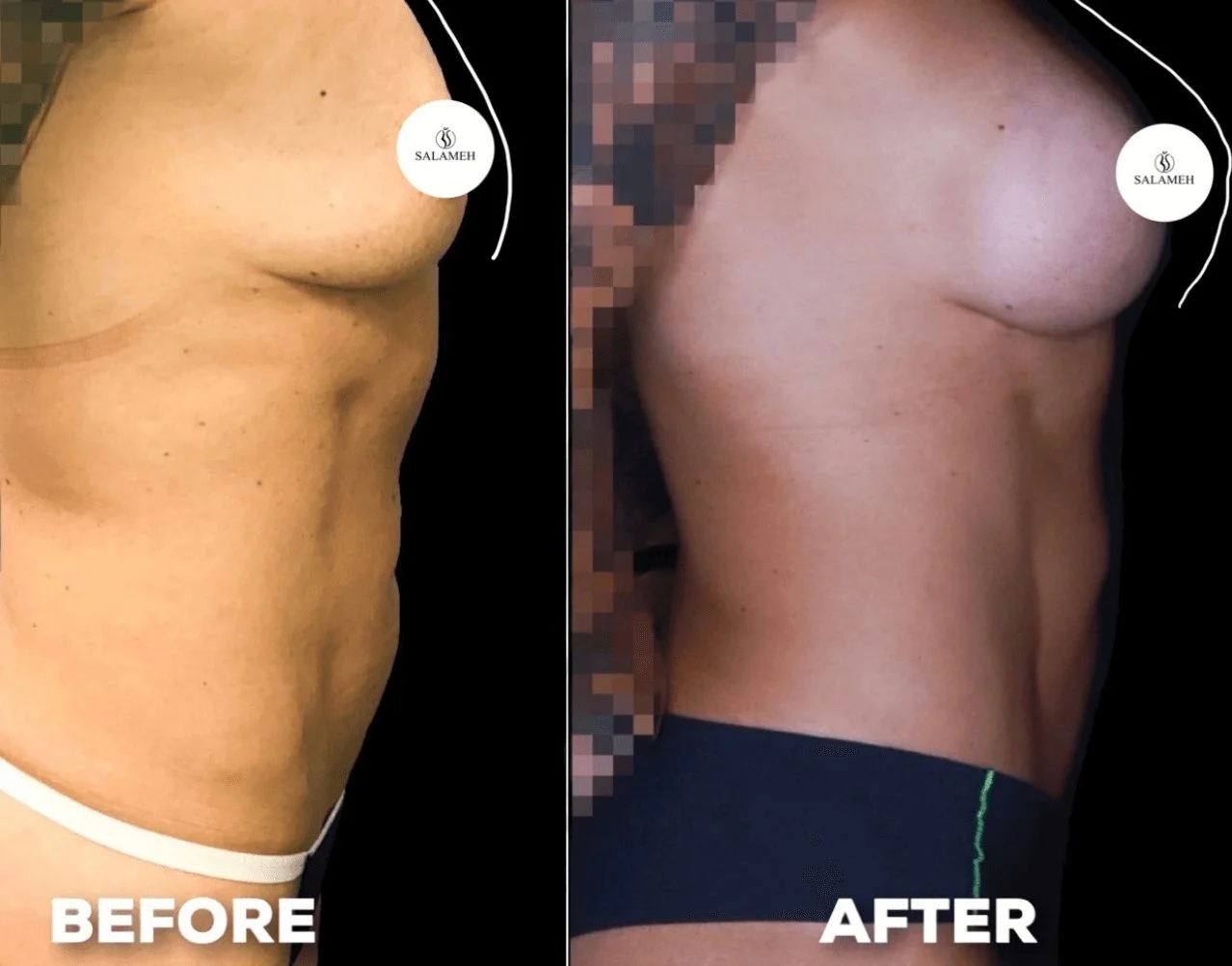 Before and after side view of breast augmentation