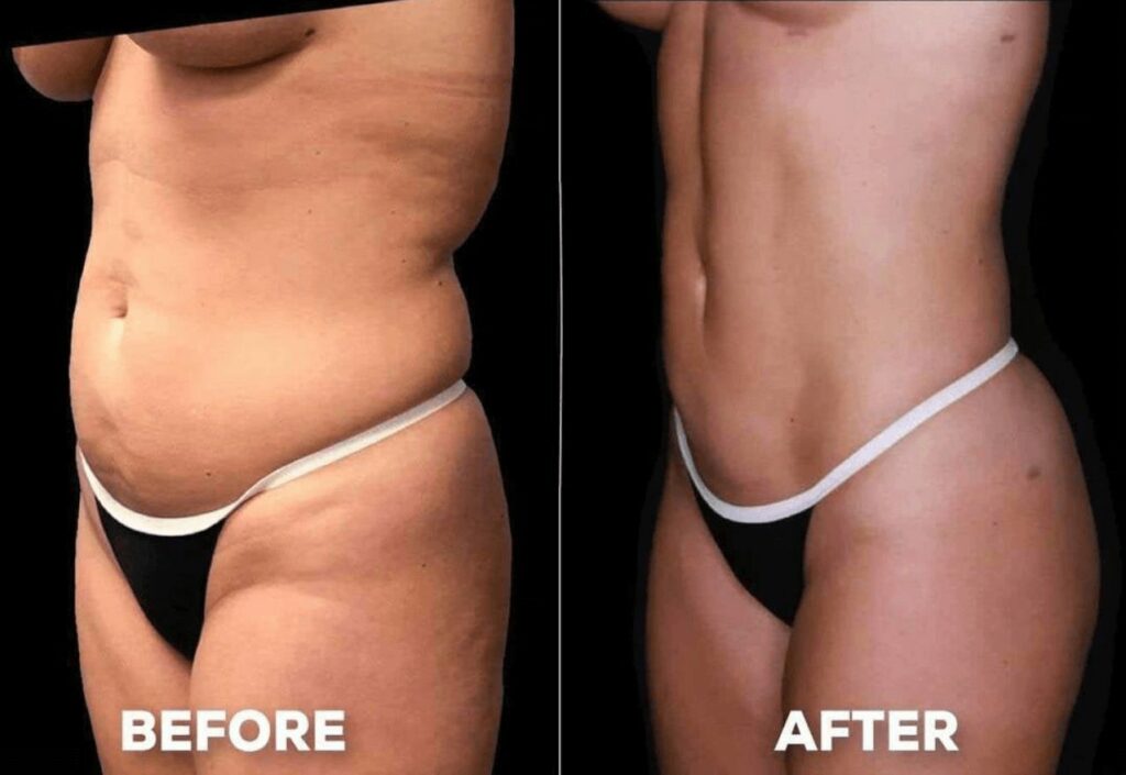 Before and after of liposuction procedure