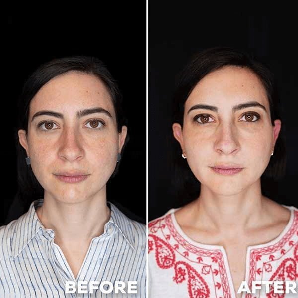 woman before after liquid facelifting 