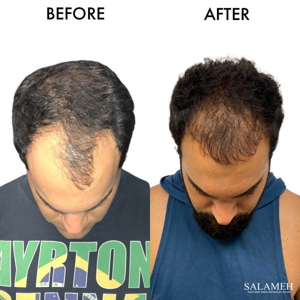 Before and after of ARTAS hair transplant