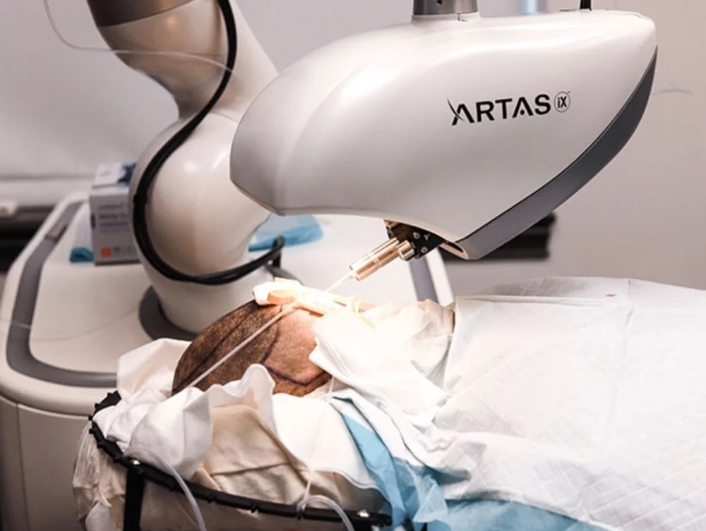 Closeup of ARTAS hair transplant machine