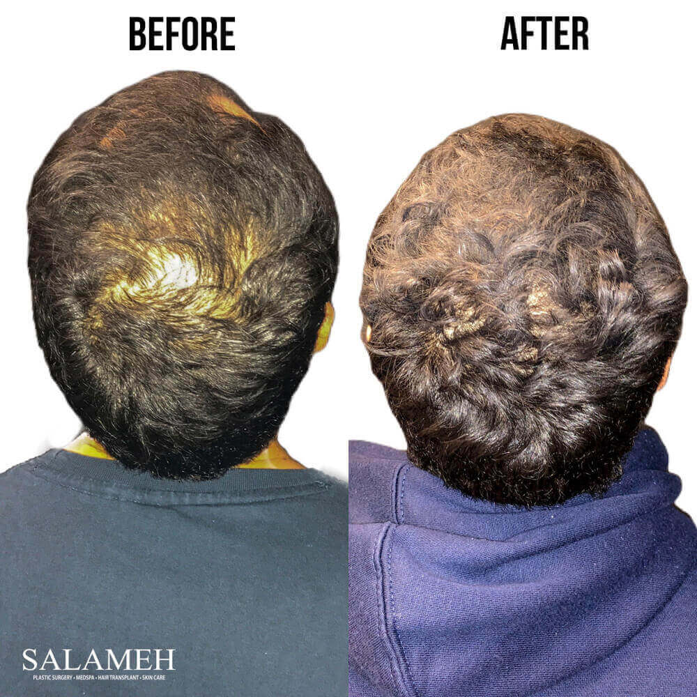 Scalp before and after hair restoration