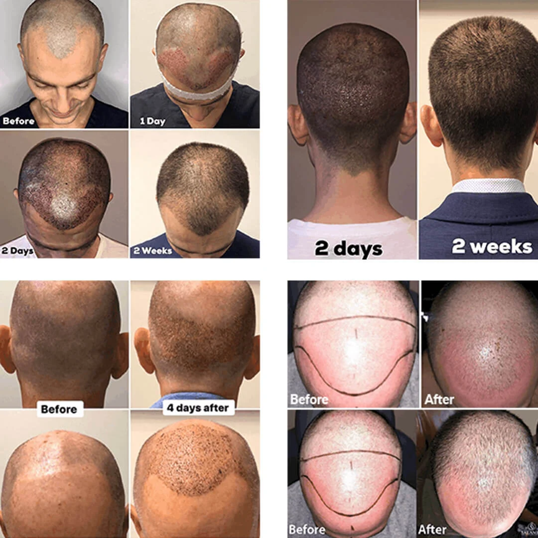Multiple pictures of hair transplant before and after