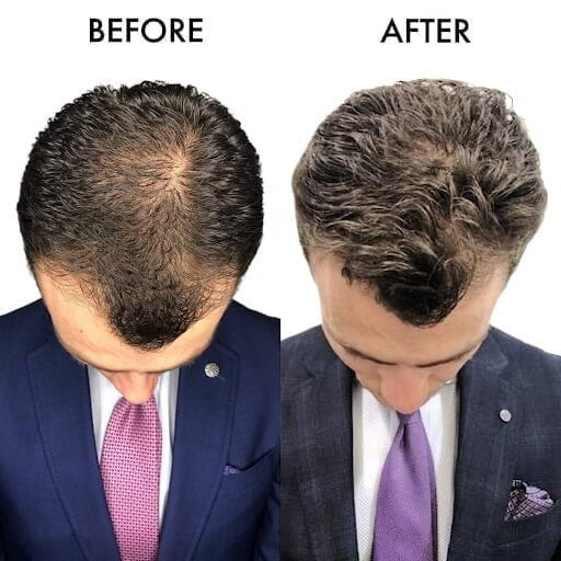 Top-down picture of hair transplant before and after