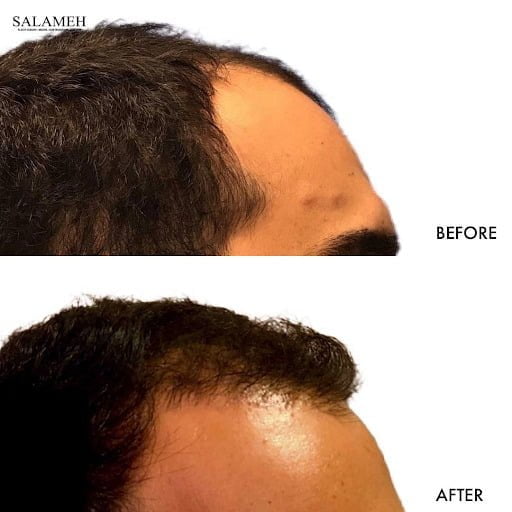 before and after of ARTAS hair transplant