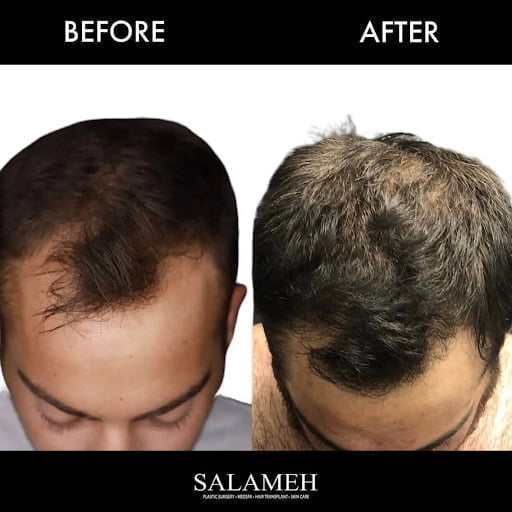before and after of ARTAS hair transplant