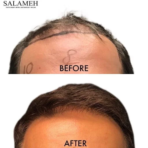 forehead before and after hair transplant
