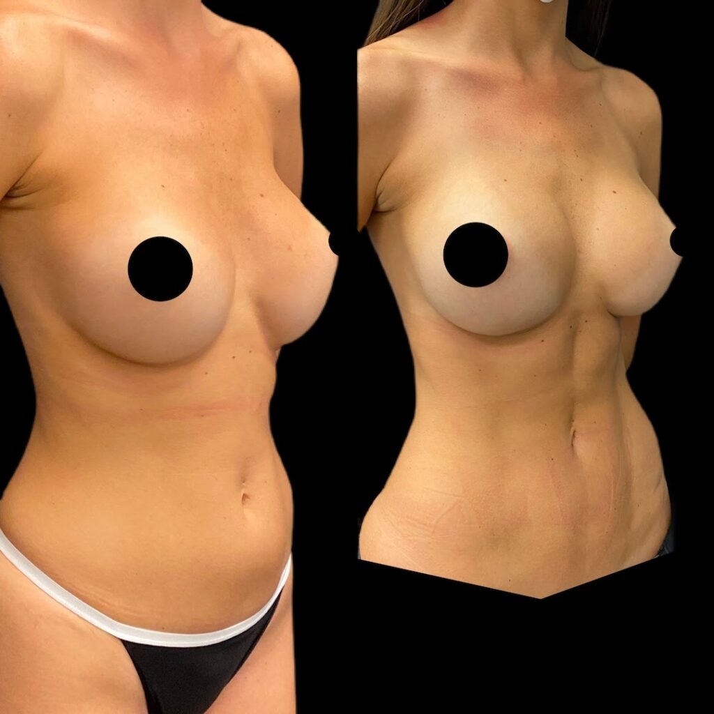 A before-and-after picture of liposuction on the stomach