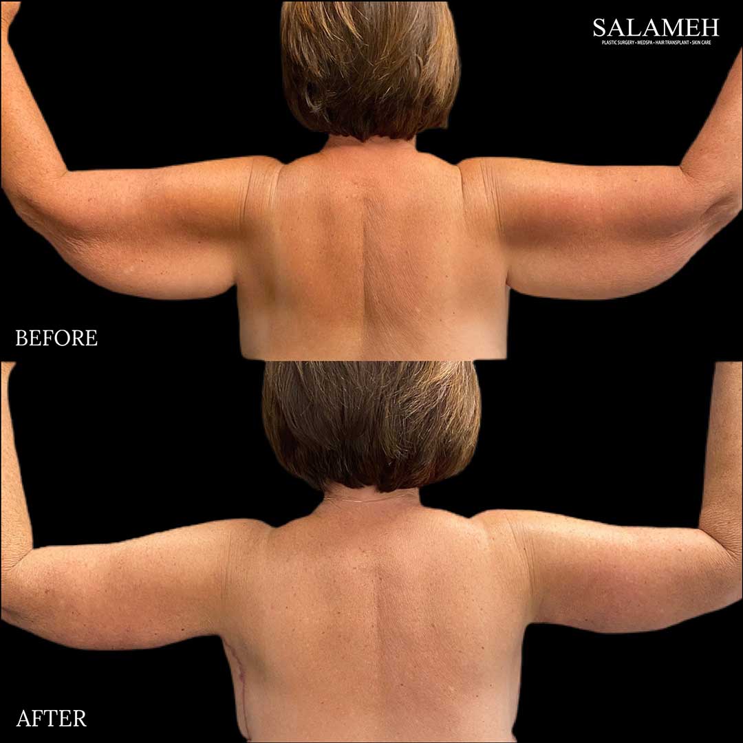 before and after of arm lift surgery