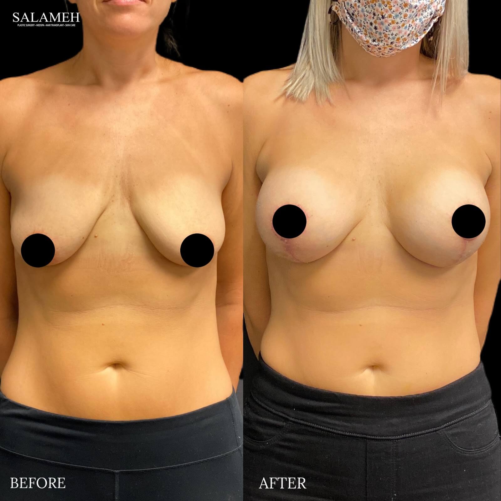 image showing the results of a breast lift, before and after