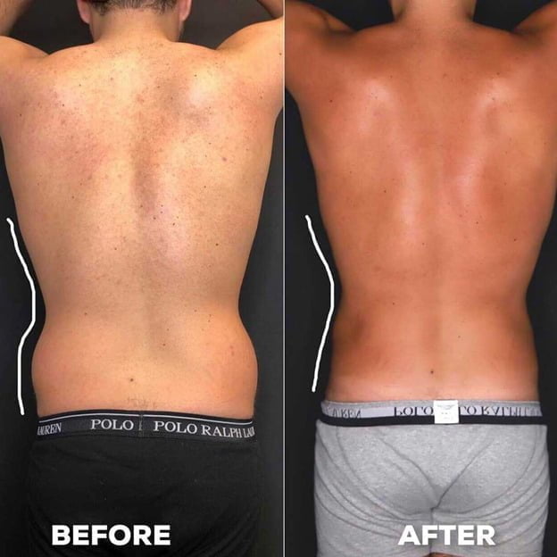 man’s back before and after liposuction