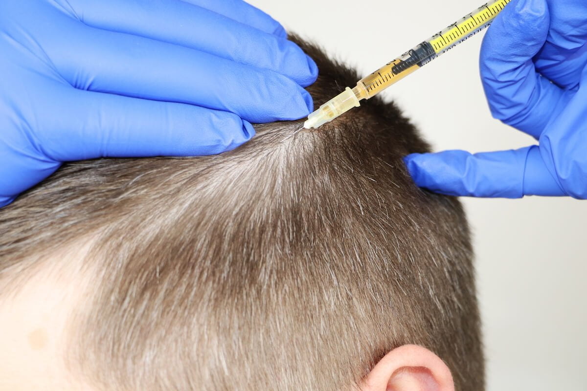 A PRP injection being done into a man’s scalp