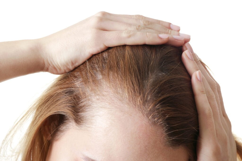 A close-up of a woman’s thinning hairline with hands smoothing the hair back