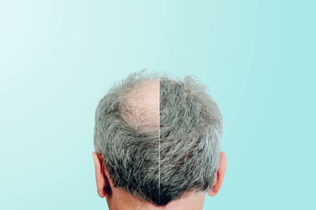 Before and after hair transplant