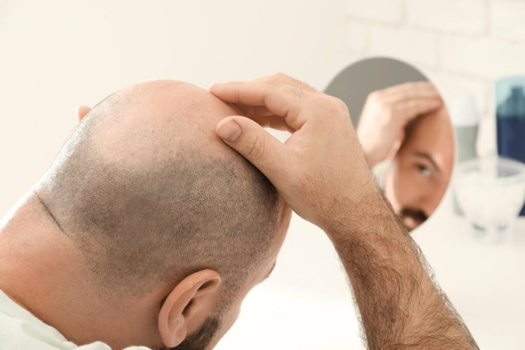 a balding man touching his head while looking in the mirror