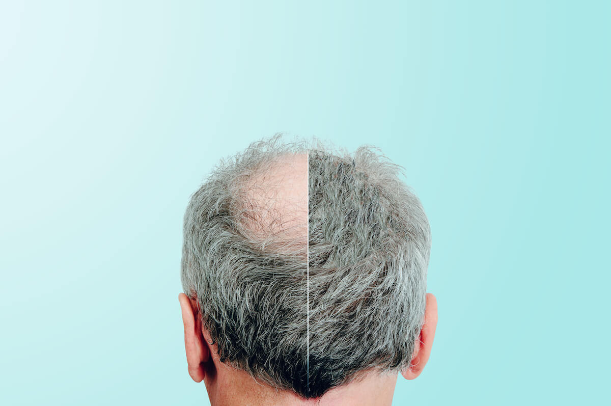 a before-and-after image of a man who had a hair transplant
