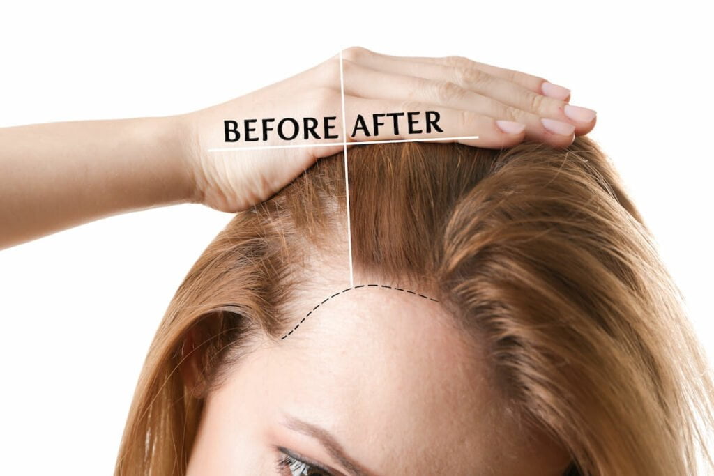 a before-and-after image of a woman who had a hair transplant