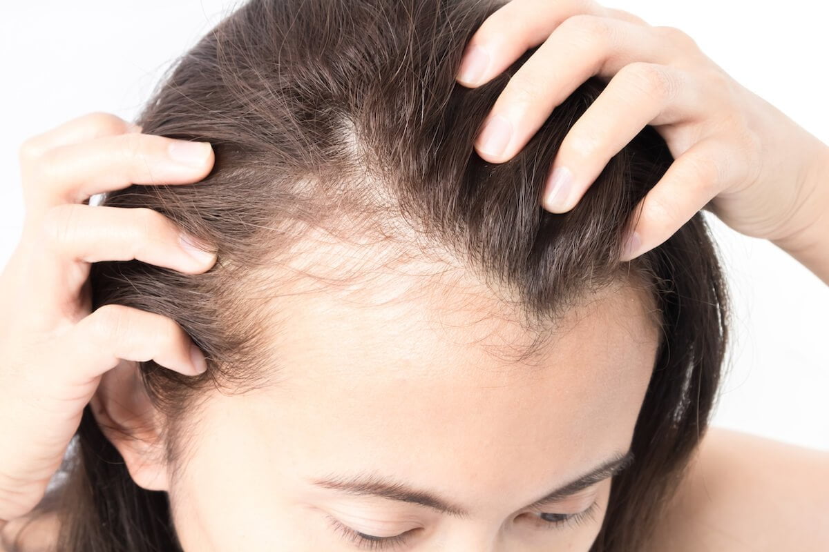 a woman parting her hair to reveal hair loss 