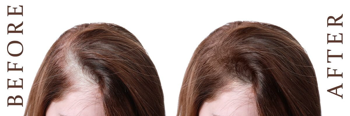 pictures of a woman before and after a robotic hair transplant