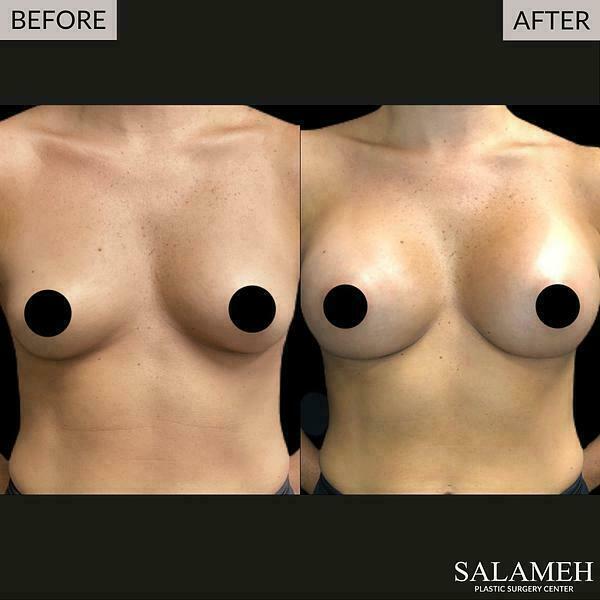 Breast augmentation before and after image with before image on the left and after image on the right. The after image shows larger breasts after implants.