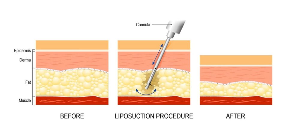Graphic illustration of before, present and after liposuction on epidemis