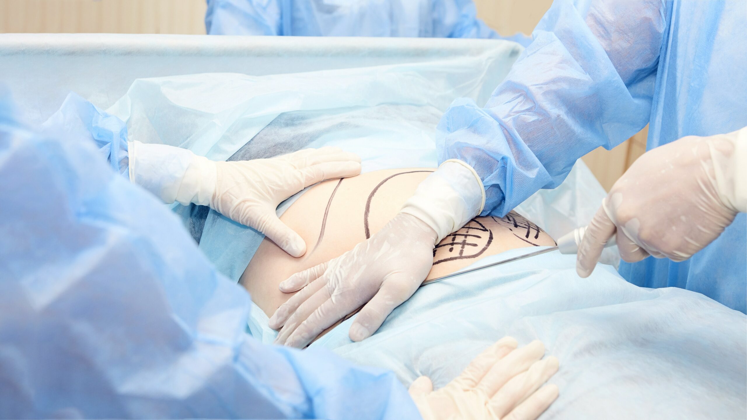 A patient covered up for operation with marking on the body with with 4 hands placing on the stomach