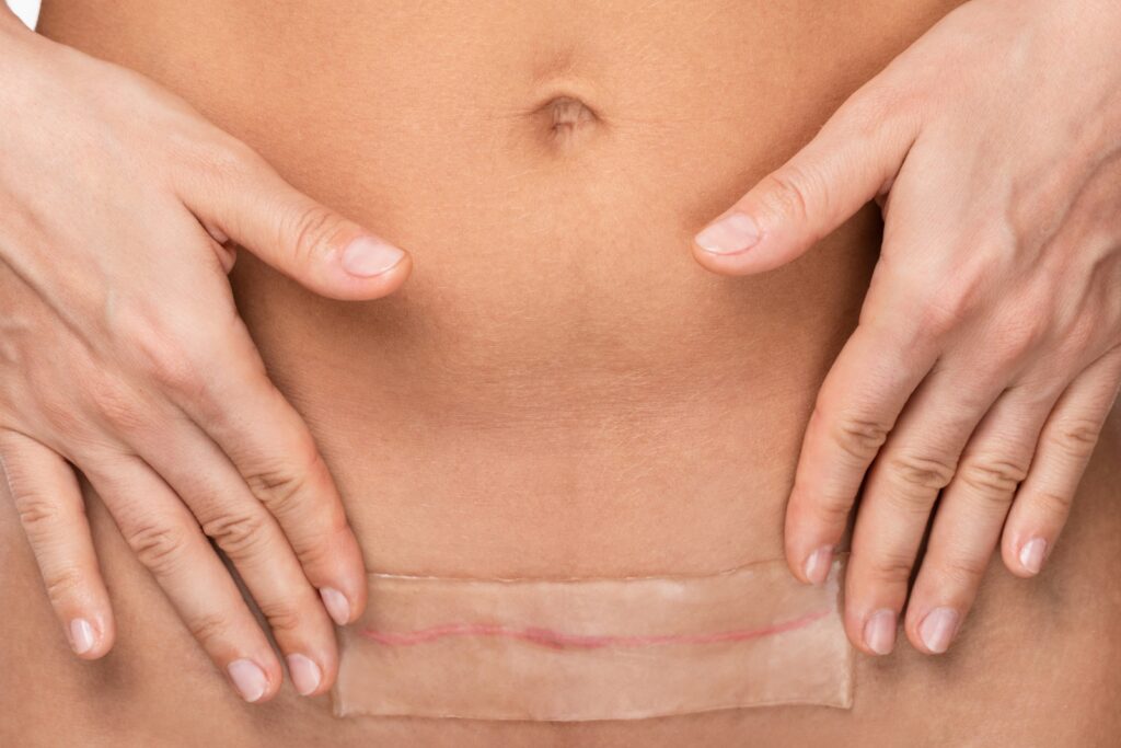 Will Tummy Tuck Scars Go Away? Effective Strategies to Reduce