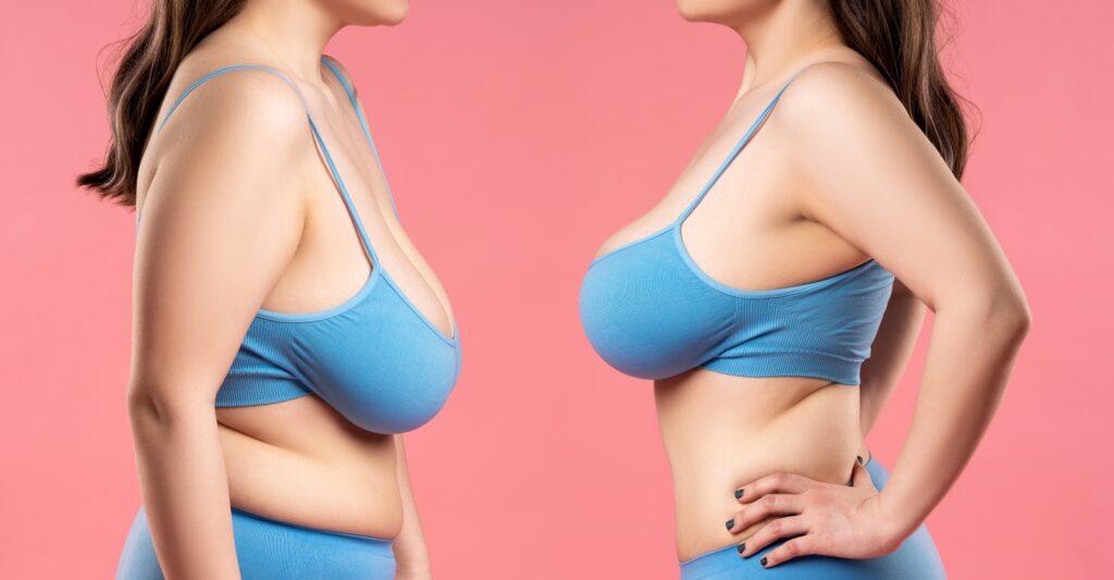 How to Fix Saggy Breasts After Breastfeeding - Salameh Plastic Surgery  Center