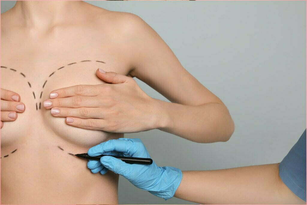 How to perform breast augmentation using a composite myofascial