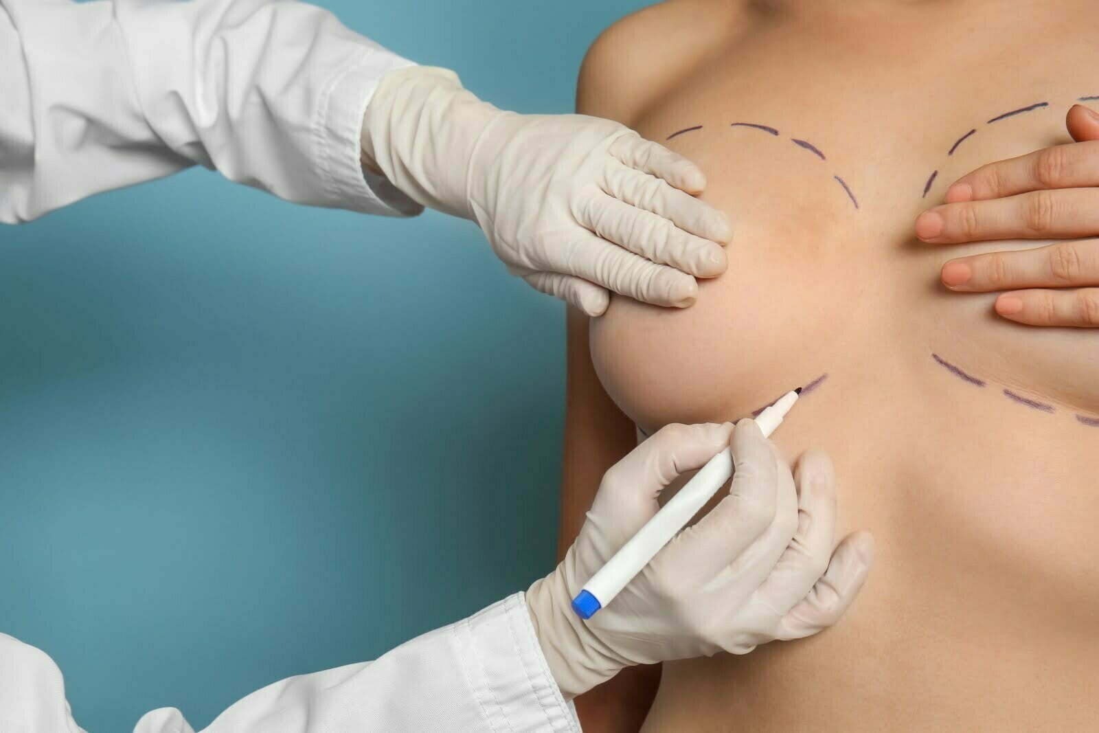 Female breast reduction in Ireland