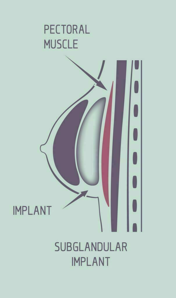 Breast Implants Over The Muscle 