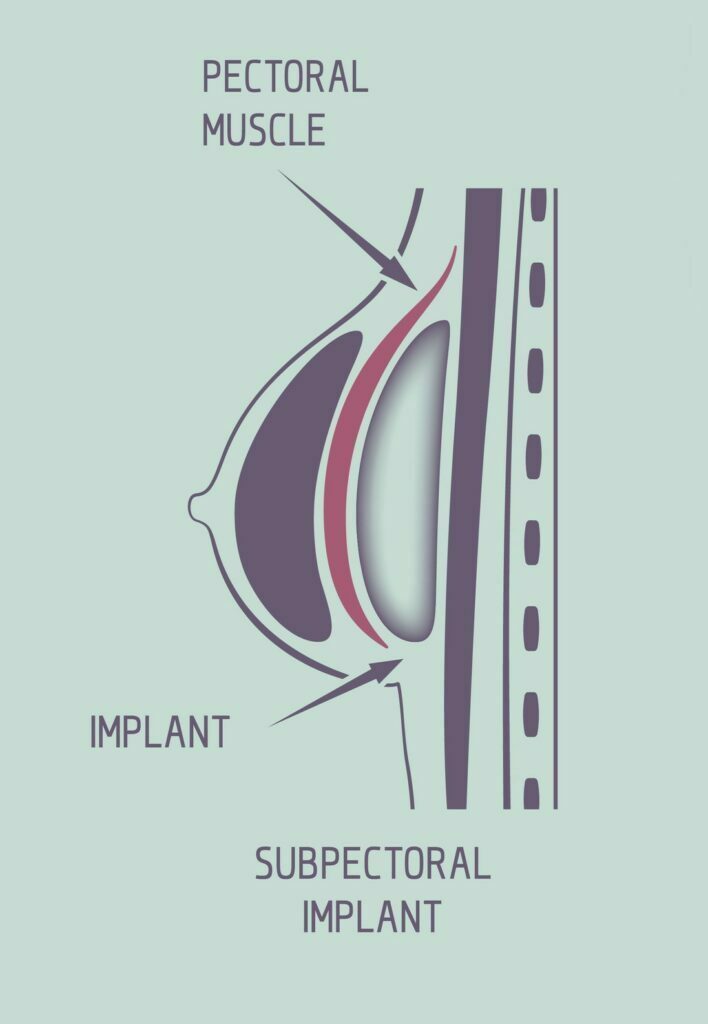 Problems With Breast Implants Under The Muscle - Salameh Plastic Surgery  Center