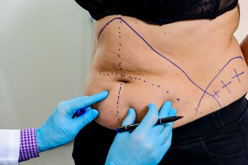 The doctor drawing lines on the patient’s skin for tummy tuck and 360 liposuction surgery