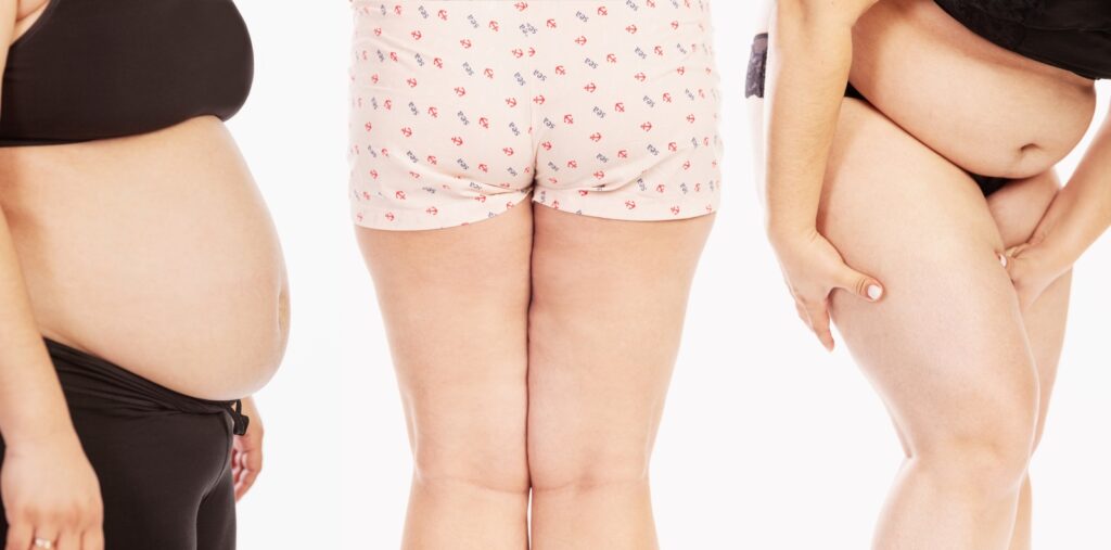 Lipedema Legs or Just Fat Legs? Crucial Things to Know - Salameh