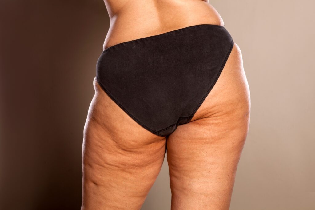 Loose skin on discount thighs and buttocks