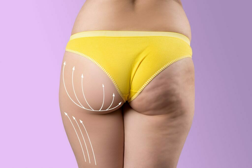 Overweight woman with fat cellulite legs and buttocks, before after concept, obesity female body with painted surgical lines and arrows