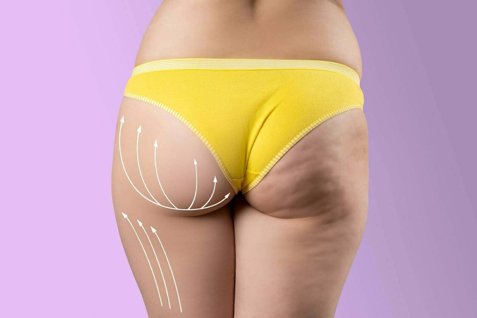 Sagging Buttocks Before And After - Salameh Plastic Surgery Center